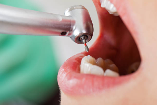 Best Broken or Chipped Tooth Repair in Augusta, GA